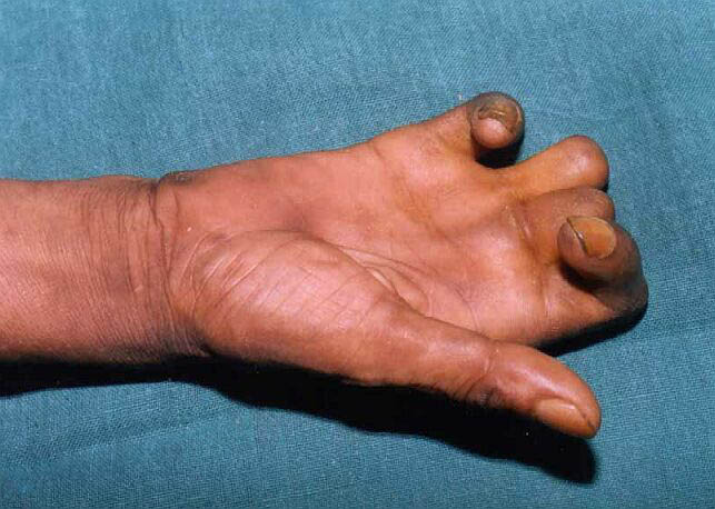 Kano records 400 new leprosy cases annually - official - Premium Times  Nigeria