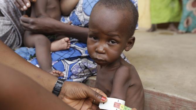 Malnourished child (Photo Credit: Sunday Alamba)
