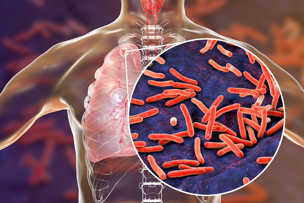 Looking harder for TB - In sub-Saharan Africa and elsewhere, By ...