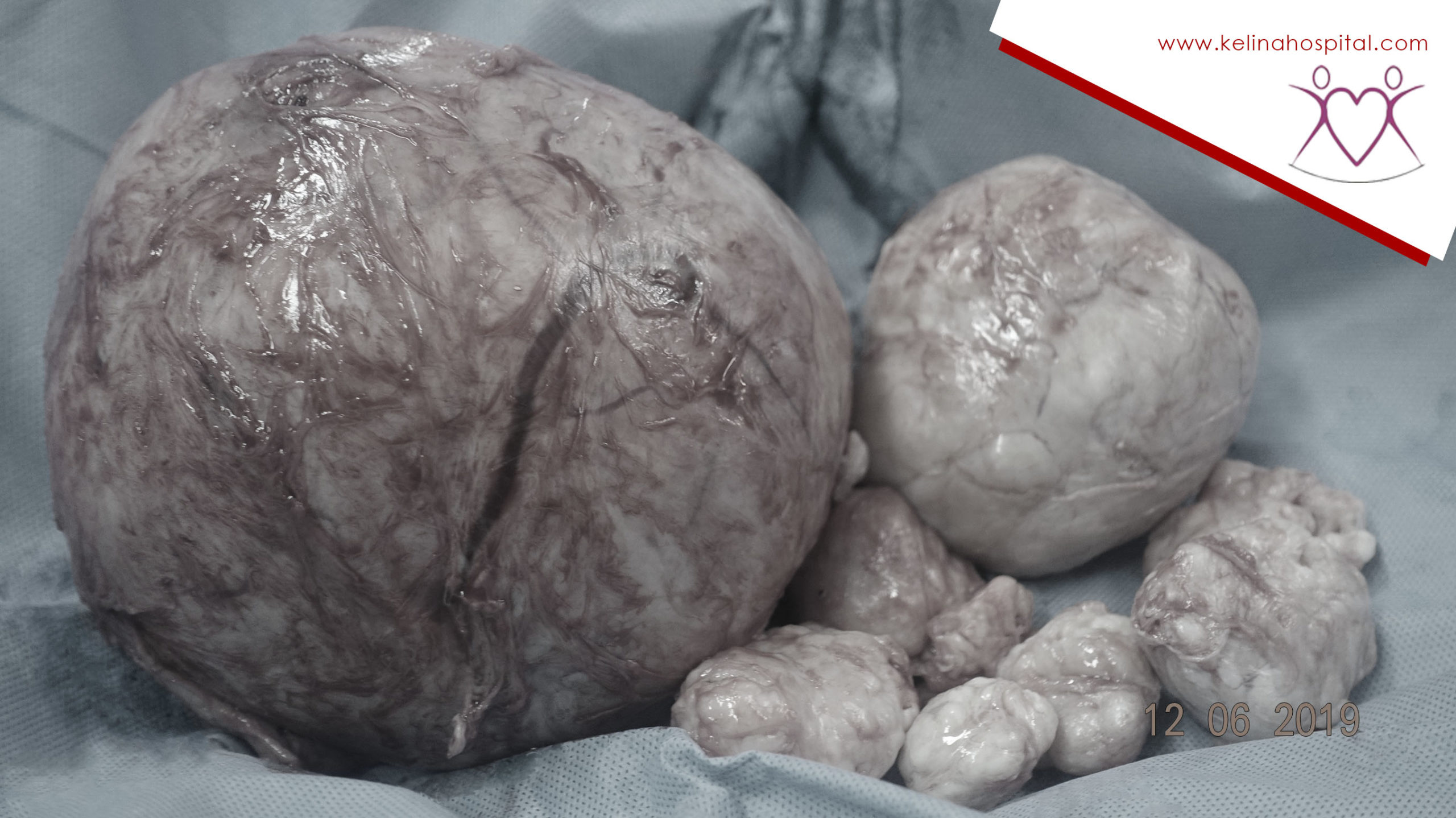 PT Health Watch: Misconceptions shaping how women respond to fibroids – Expert