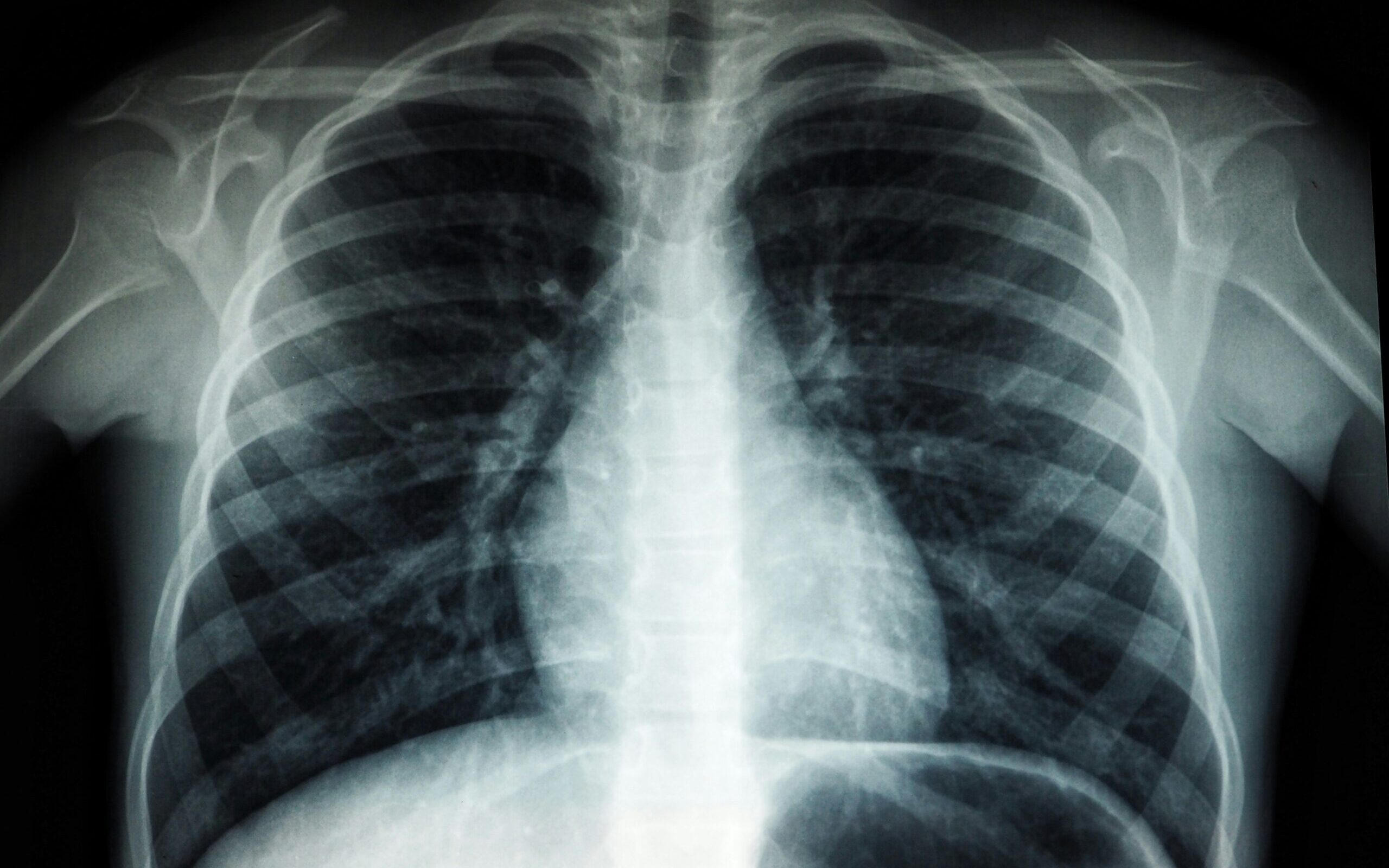 US CDC supports expansion of AI-enabled X-ray machines to tackle Nigeria’s TB-HIV burden