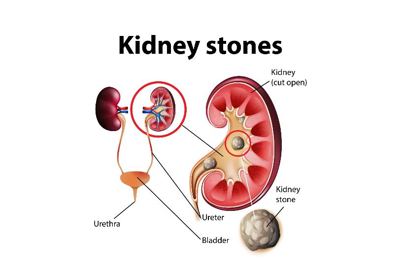 PT Health Watch: What you need to know about Kidney stones